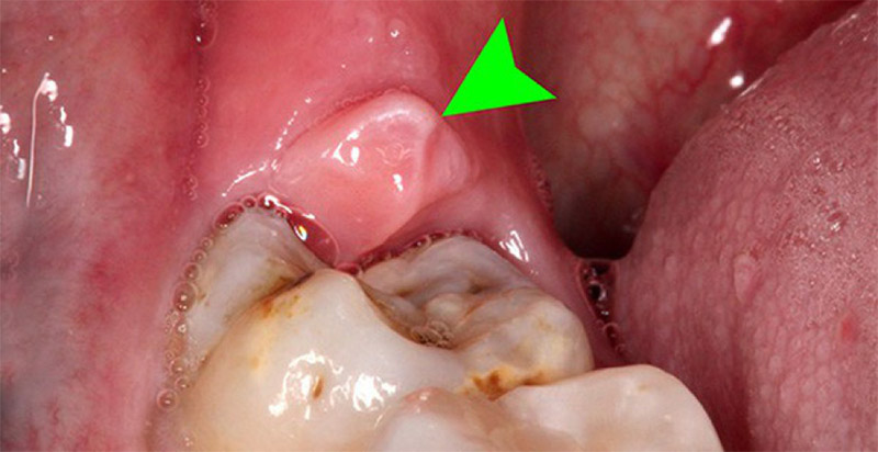 Biện Pháp Phòng Ngừa Đau Răng Số 8