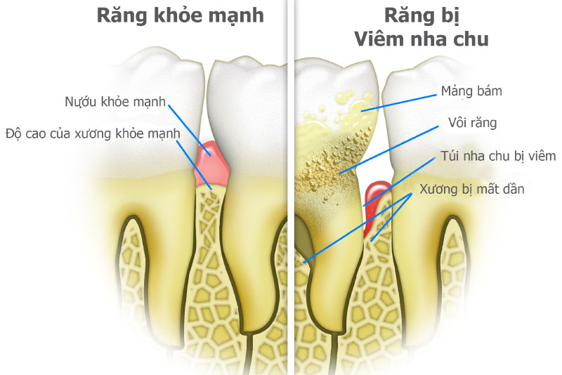 Có những loại thức ăn cần hạn chế để không bị viêm nha chu?
