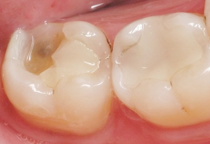 Việc trám răng hay không, các nha sĩ sẽ dựa trên tình trạng sâu của răng. Với tình trạng răng sâu mới “chớm”, các nha sĩ sẽ chỉ định bệnh nhân điều trị răng sâu bằng Fluoride. Đây là phương pháp sử dụng Fluoride dưới dạng gel hoặc bọt bôi lên bề mặt răng giúp khôi phục men răng - phần men răng đã bị vi khuẩn gây sâu răng bào mòn đi phần nào. Nếu vượt qua giai đoạn này, các nha sĩ sẽ chỉ định bệnh nhân loại bỏ phần men và ngà bị tổn thương đồng thời khôi phục lớp bảo vệ răng bằng vật liệu trám răng.