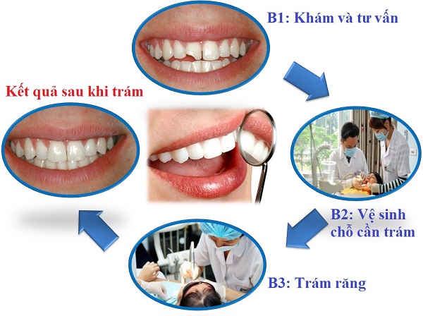Kiểm tra và tư vấn: đây là giai đoạn đầu tiên. Các nha sĩ sẽ tiến hành kiểm tra tổng quát về tình trạng răng miệng của bệnh nhân. Từ đó, bác sĩ sẽ tư vấn về quy trình thực hiện cũng như những vật liệu sử dụng cho chỗ trám. Gây tê và vệ sinh: Để đảm bảo sự thoải mái cho bệnh nhân trong quá trình thực hiện trám răng, các nha sĩ sẽ tiến hành gây tê cục bộ vị trí răng cần trám. Phần răng bị sâu sẽ được loại bỏ và làm sạch bằng những dụng cụ chuyên biệt. Tiến hành trám: Nha sĩ sẽ đưa vật liệu trám vào trong khoang răng sâu đã được tiến hành làm sạch. Sau đó, các nha sĩ sẽ sử dụng đèn Laser để là vật liệu trám trông cứng lại. Đồng thời bám chắc vào phần thân răng nhờ phản ứng quang trùng hợp. Chỉnh sửa: Đây là bước cuối cùng của quy trình trám răng. Ở giai đoạn này, nha sĩ sẽ tiến hành kiểm tra độ tương thích của khớp cắn bằng cách loại bỏ vật liệu dư thừa. Cuối cùng các nha sĩ sẽ tiến hành mài nhẵn và đánh bóng để đảm bảo bề mặt trám sẽ được mô phỏng như răng thật.