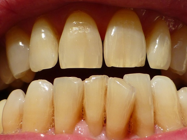 Khi sử dụng kháng sinh Tetracycline, các hoạt chất của nó sẽ ngấm vào mô răng (canxi) mới hình thành. Từ đó khiến răng bị nhiễm màu ngà. Nếu người mẹ đang mang thai uống thuốc này thì thai nhi có thể có hàm răng ngả vàng bẩm sinh. Tương tự trẻ em dưới 8 tuổi khi uống kháng sinh này cũng sẽ gặp tình trạng đó. Sự nhiễm màu răng từ Tetracycline có thể chia ra nhiều mức độ khác nhau. Bao gồm: vàng, nâu, xám, tím.