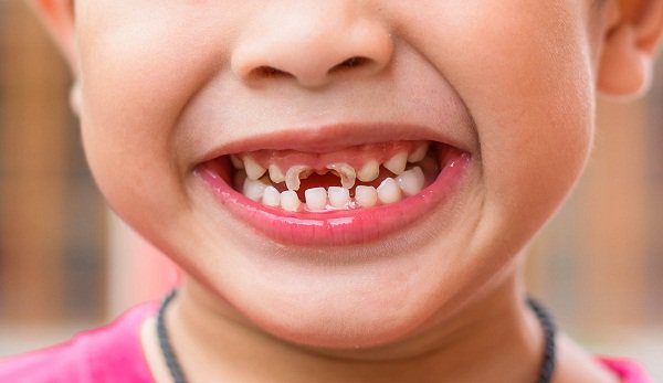 Sâu răng sẽ khiến trẻ đau nhức, quấy khóc, khó ăn uống. Hệ luỵ của việc này sẽ khiến trẻ suy dinh dưỡng, chậm phát triển. Sâu răng ở trẻ em nếu không được chữa trị kịp thời sẽ gây ra tình trạng thối tủy ở răng sữa. Trong trường hợp xấu nhất, nha sĩ sẽ buộc phải loại bỏ răng sâu. Với răng sữa ở trẻ em, nếu răng bị loại bỏ quá sớm trước thời kỳ thay răng. Răng vĩnh viễn sẽ bị ảnh hưởng: chậm mọc hoặc mọc lệch. Điều này sẽ ảnh hưởng rất nhiều đến hàm răng vĩnh viễn của trẻ sau này.