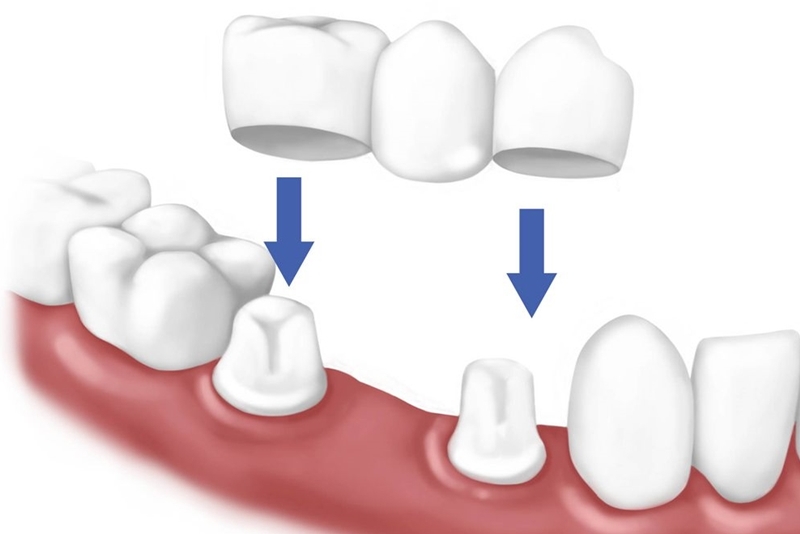 Tìm hiểu làm cầu răng sứ sử dụng được bao lâu và những yếu tố ảnh hưởng