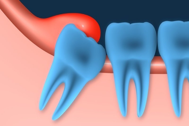 Muối hột rang nóng có tác dụng gì trong việc chữa viêm lợi trùm?
