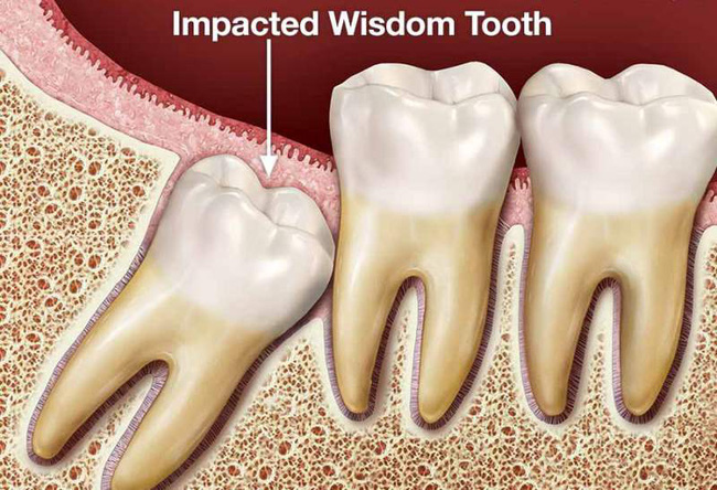 Những trường hợp bắt buộc phải loại bỏ răng khôn Răng khôn mọc không thẳng, thiếu chỗ Răng khôn gây cản trở và hình dạng bất thường, dị dạng. Răng khôn có bệnh liên quan đến nha chu hoặc sâu răng