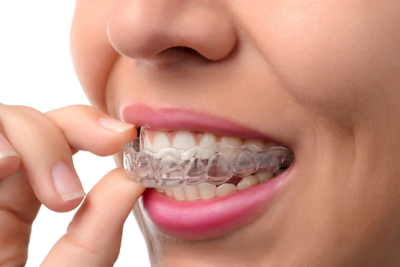 Phương pháp phổ biến nhất giúp điều trị răng hô là gì? Niềng răng hô là một trong những phương pháp điều trị răng hô phổ biến nhất hiện nay. Đây là phương pháp vật lý sử dụng các mắc cài và dây cung được gắn trên răng. Những mắc cài và dây cung này sẽ được điều chỉnh để căng kéo và đưa răng về đúng vị trí mọc. Với phương pháp niềng răng bạn sẽ mất từ 2-3 năm để răng có thể về đúng vị trí.