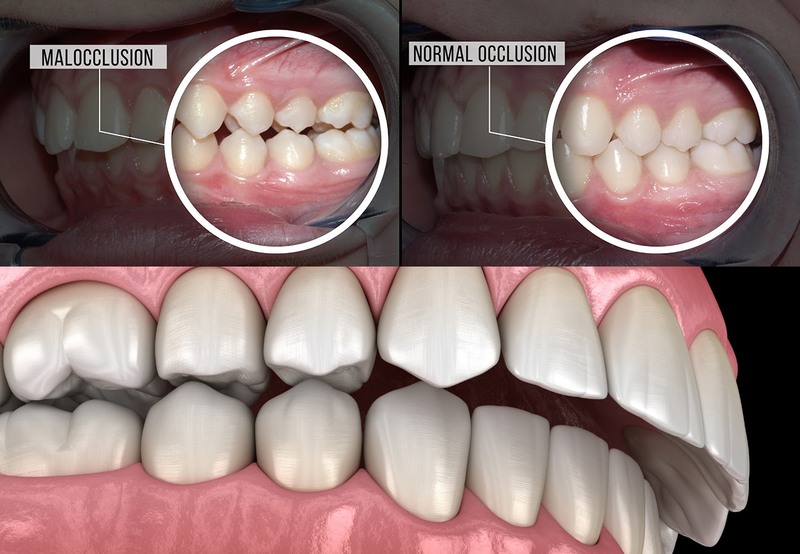 Những kiểu răng răng hô phổ biến Hô do răng: Đây là tình trạng các răng mọc trong hàm trên có xu hướng mọc hướng ra ngoài. Trong khi đó, nếu mọc chuẩn các răng phải mọc theo phương thẳng đứng. Điều này khiến răng bị chìa ra ngoài. Hô do xương hàm: Với trường hợp này, răng mọc bình thường theo phương thẳng đứng. Tuy nhiên, phần xương hàm trên lại phát triển quá mức. Điều này dẫn tới phần hàm trên bị nhô ra quá nhiều so với hàm dưới và gây hô/ Hô do cả răng và xương hàm: Răng hô do cả răng và xương hàm. Đây là trường hợp hô nặng. Nguyên nhân gây ra tình trạng này là do phần răng mọc lệch ra ngoài. Đồng thời phần hàm trên cũng bị phát triển quá mức. Dẫn tới phần hàm trên vừa mọc lệch vừa nhô ra rất nhiều so với hàm dưới.