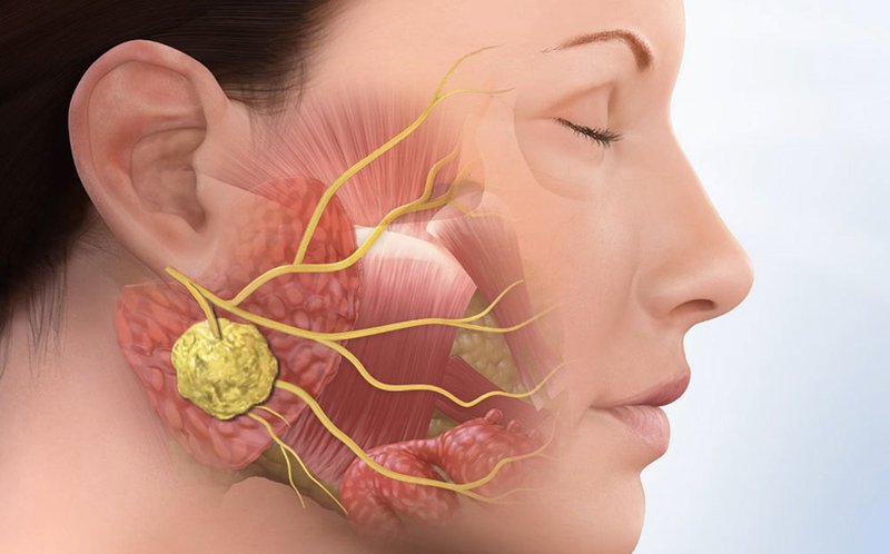 Nếu không được xử lý kịp thời răng khôn mọc ngang hay mọc lệch sẽ gây ra u nang xương hàm. Gây hỏng xương hàm, răng và cả dây thần kinh. Nếu quá nặng bác sĩ sẽ loại bỏ mô và xương, gây ảnh hưởng lớn tới sức khỏe răng miệng.