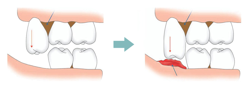 Ở độ tuổi trưởng thành (18-25 tuổi), cấu trúc xương hàm đã phát triển ổn định. Răng khôn mọc vào độ tuổi này khiến hàm không có cơ chế thích nghi phù hợp. Dẫn đến tình trạng sưng, đau nhức. Nếu cơn đau chỉ kéo dài một thời gian và biến mất thì không vấn đề gì. Tuy nhiên, ở nhiều trường hợp, răng khôn mọc lệch trong cung hàm. Từ đó, gây ra tổn thương nghiêm trọng vùng nướu xung quanh và cơn đau khó dứt.