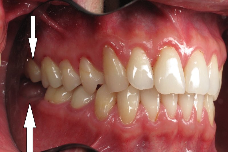 Răng khôn hàm trên là gì? Giải quyết đau răng khôn hàm trên thế nào?