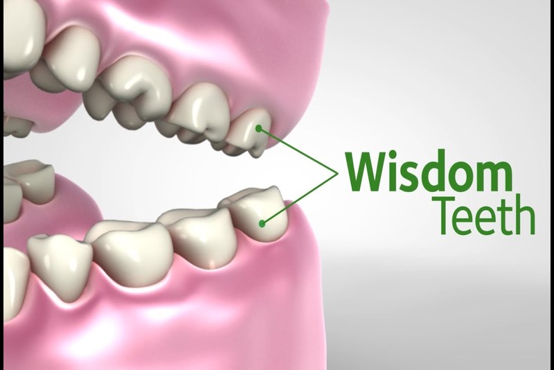 Răng khôn nằm ở phần nào của cung hàm?
