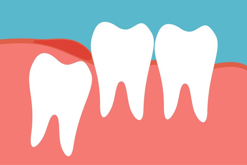 Răng khôn là răng số mấy? Có nên nhổ răng khôn hay để lại? - NKTĐ