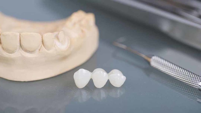 Mão răng nhựa được làm từ vật liệu nhựa composite. Là sự kết hợp của các loại vật liệu nhựa có màu phù hợp với răng tự nhiên. Các loại nhựa thông dụng được sử dụng để tạo ra các mão này bao gồm: nhựa silicon dioxide, nhựa Polymethyl Methacrylate hoặc nhựa acrylic.