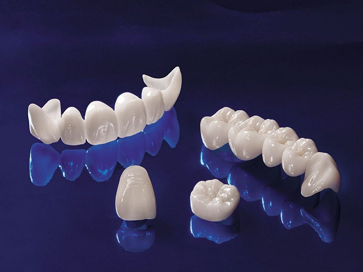 Sứ Feldspathic là vật liệu sứ truyền thống, tiêu chuẩn. Đã được sử dụng để tạo mão răng trong nhiều năm. Nó là một vật liệu cung cấp một diện mạo rất tự nhiên như răng thật. Những mão này được tạo ra bằng cách tùy chỉnh lớp sứ. Và có thể được gắn trực tiếp vào bề mặt răng tự nhiên