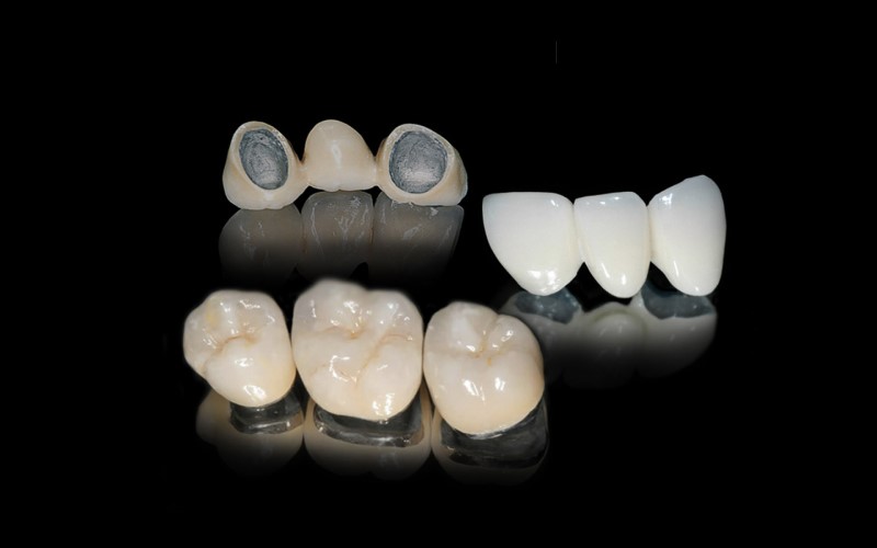 Mão PFM được tạo thành từ hai thành phần. Lõi của chúng được làm từ kim loại. Đây là phần bên trong của mão răng nằm trên và được gắn vào răng tự nhiên. Sứ sau đó được xếp lớp và gắn với đế kim loại. Để tạo cho mão răng hình dạng và màu sắc giống như răng thật.