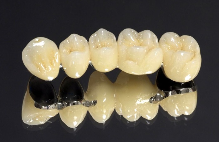 Một số nhược điểm khác của mão PFM là theo thời gian, đặc biệt là khi nướu bị rút, kim loại bên dưới để lộ ra đường viền tối màu. Các loại sứ được sử dụng cũng có độ mài mòn và có thể làm mòn răng đối diện.