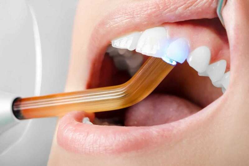 Tại sao trám kẽ răng thưa là một phương pháp phổ biến trong nha khoa?