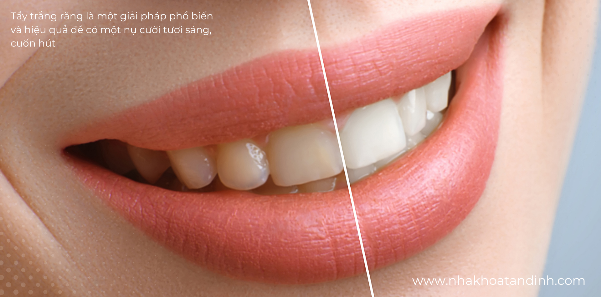 Tẩy trắng răng là một phương pháp hiệu quả để loại bỏ nhiễm màu và làm sáng răng.