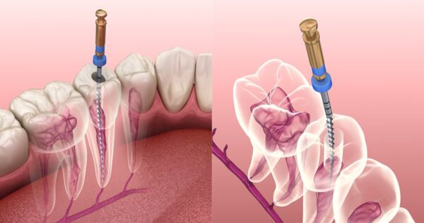 Phương pháp điều trị tuỷ