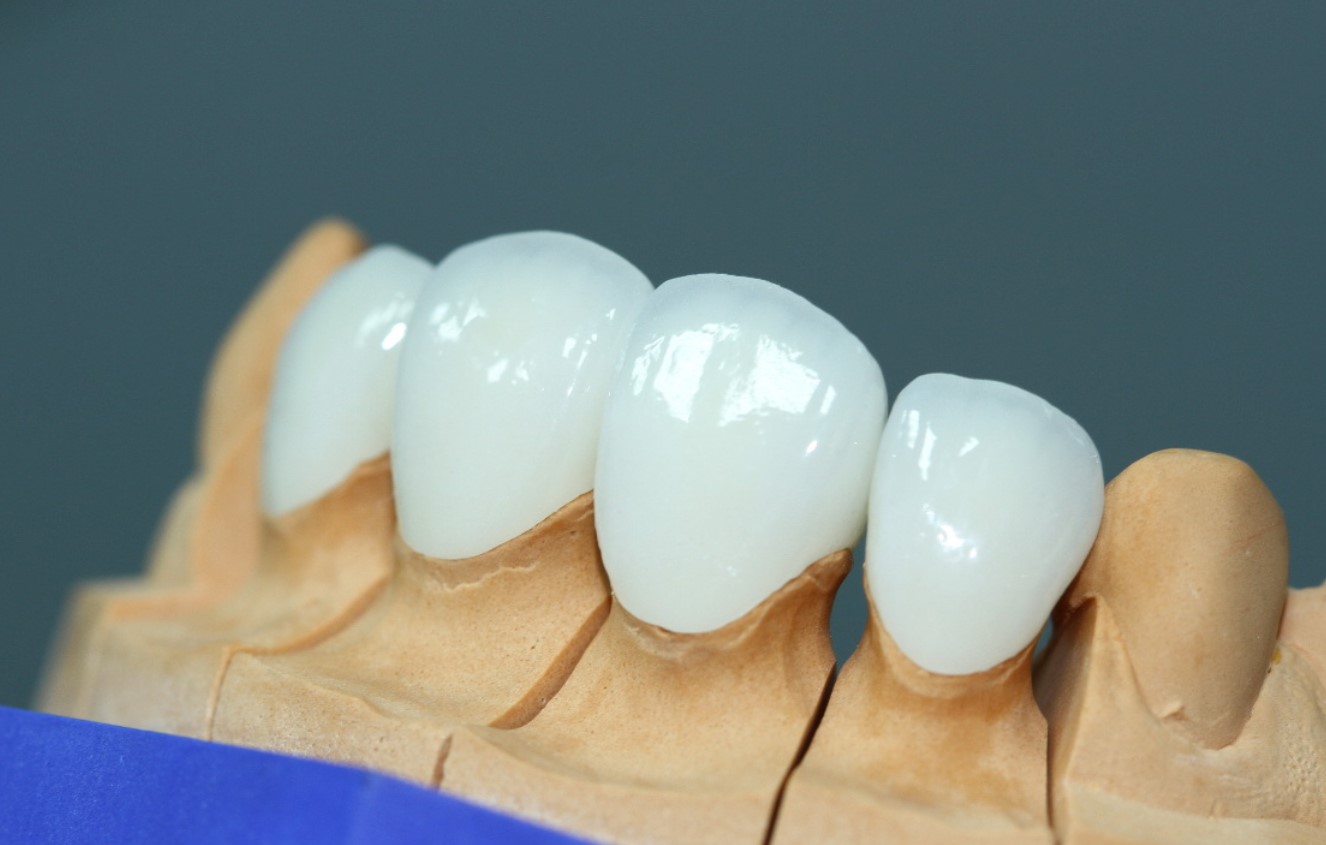 Cercon HT và Emax đều là dòng răng toàn sứ cao cấp