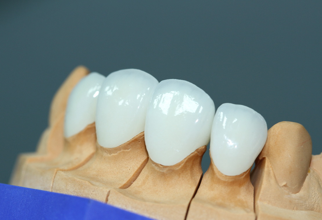 Có Nên Bọc Răng Sứ Toàn Sứ Không? Mọi Điều Bạn Cần Biết Trước Khi Làm