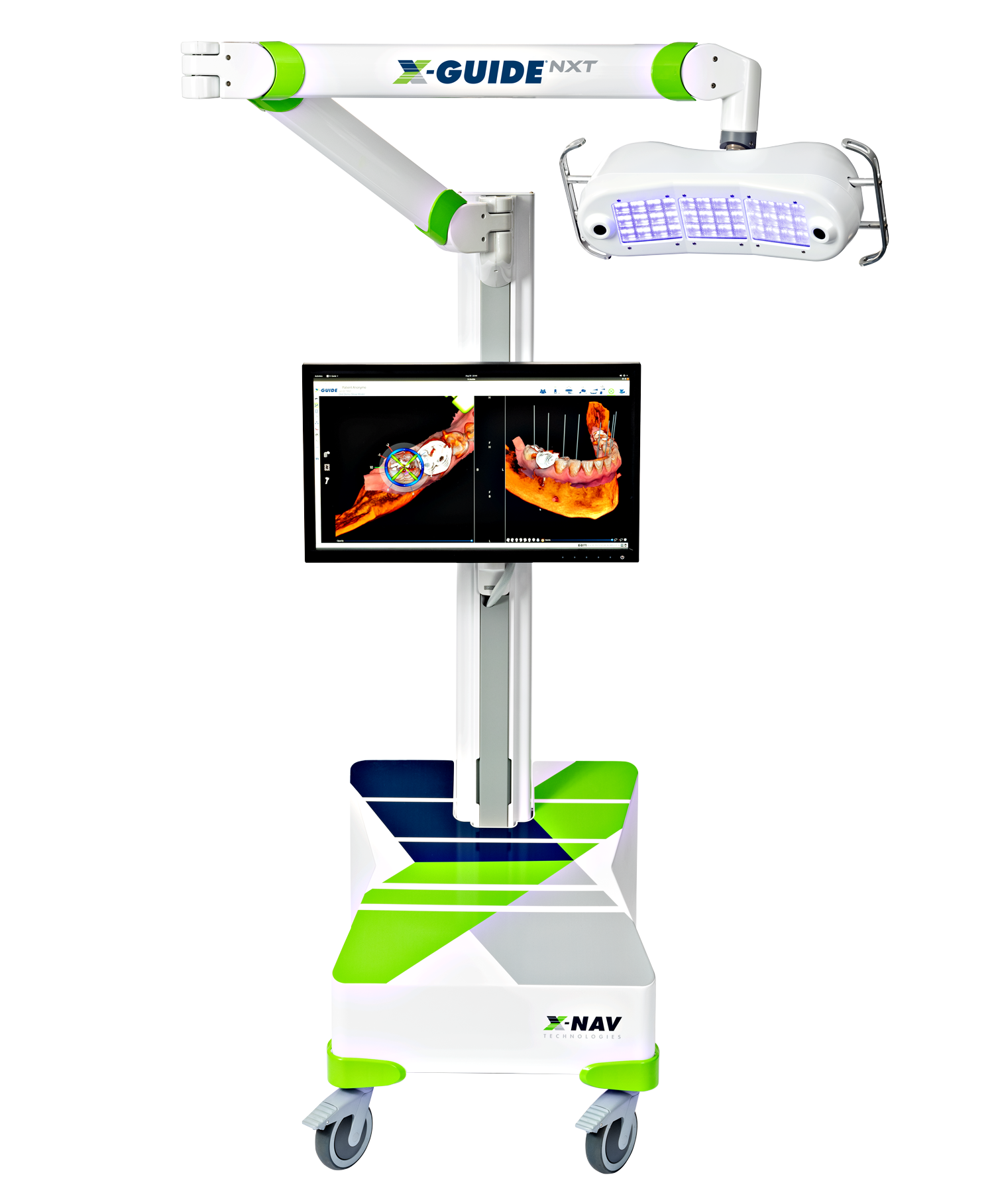 Công nghệ X-Guide định vị 3D trong cấy ghép Implant