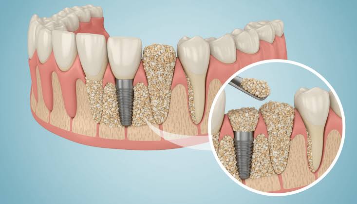 Ghép xương cấy Implant: Khi nào cần? Có đau không? Bao lâu thì lành?