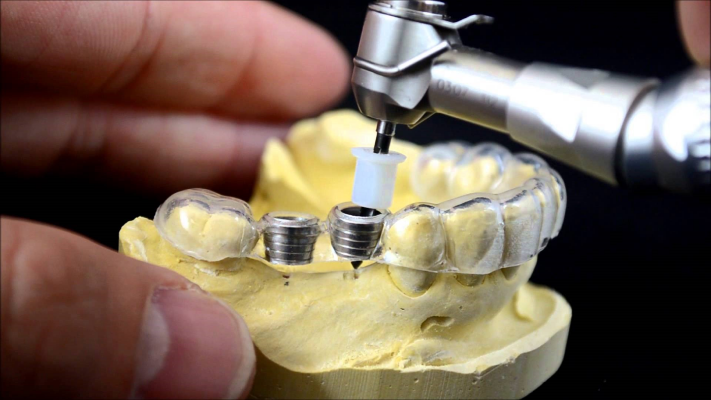Máng hướng dẫn phẫu thuật Implant là gì? Có cần thiết không?