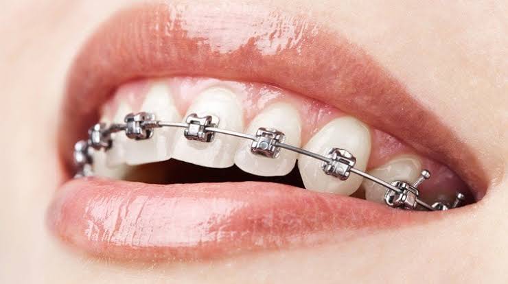Niềng răng mắc cài kim loại: Phân loại, bảng giá và những lưu ý