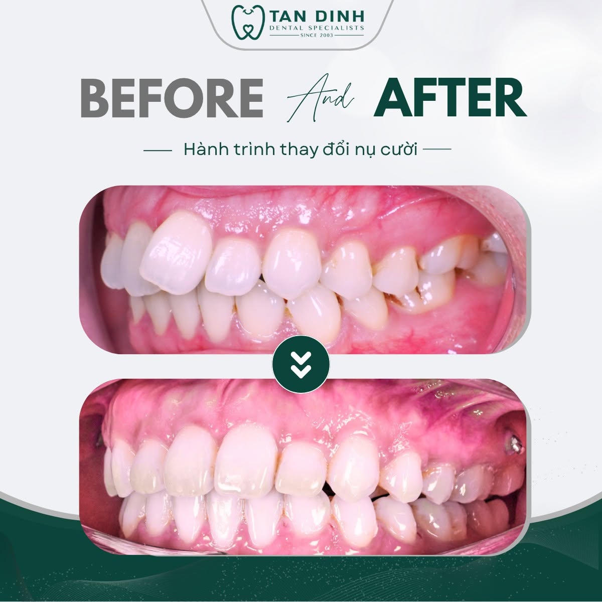 Lựa chọn đúng địa chỉ nha khoa uy tín sẽ giúp quá trình niềng răng nhẹ nhàng và nhanh hơn