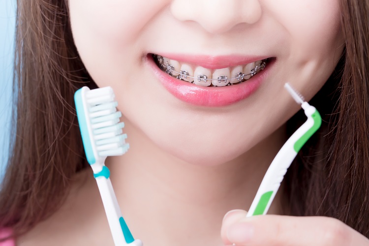 Nên dùng bàn chải kẽ để làm sạch răng trong quá trình niềng