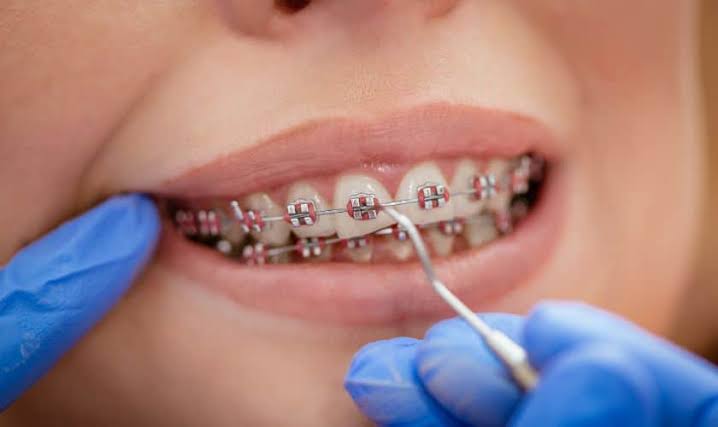 Niềng răng mắc cài kim loại phù hợp với mọi tình trạng răng hô, móm, khấp khểnh từ đơn giản đến phức tạp