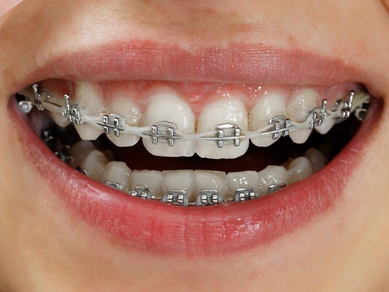 Niềng răng mắc cài thời gian bao lâu tuỳ thuộc vào nhiều yếu tố